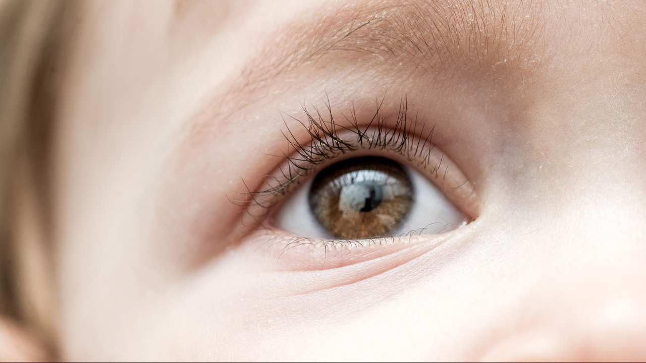 Doğuştan Göz Kapağı Düşüklüğü Tedavisi