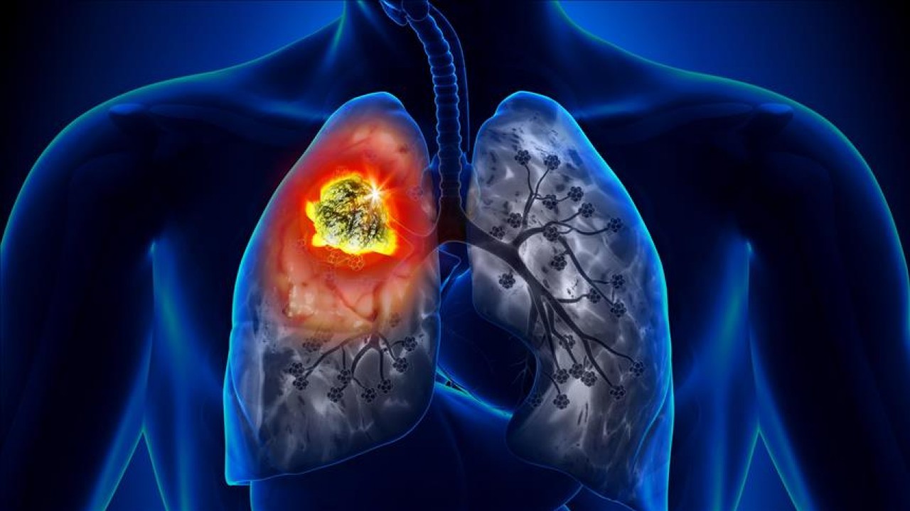 Akciğer kanseri hastalarını boğularak ölmekten kurtaran yöntem!