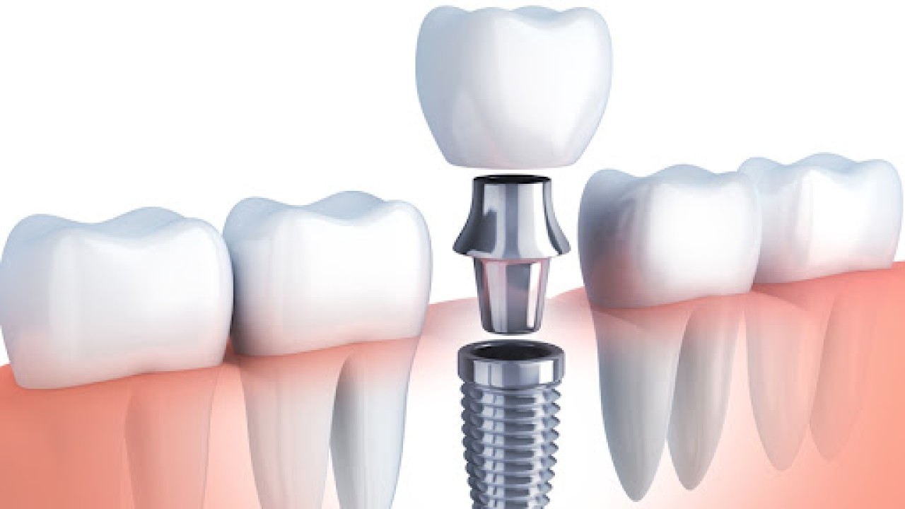 Zigomatik İmplant Nedir? Hangi Durumlarda Tercih Edilir?